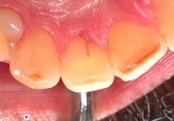 重度歯周病の抜歯